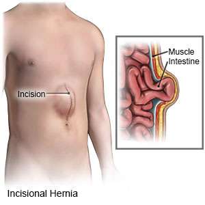 incisional hernia