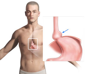 hiatal hernia